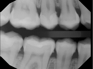 SRP Dental Code: Scaling and Root Planing Dental Code for Providers ...
