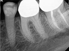 Core Buildup Dental Code: How to Avoid Claim Denials for Crowns | Delta ...