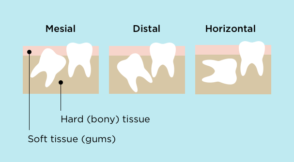Mesial impaction is when the tooth comes in angled towards other teeth, while distal means angled away from other teeth. Horizontal impaction is when teeth grow in sideways. Teeth can be impacted in hard (bony) tissue or soft tissue (gums).