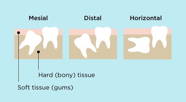 Mesial impaction is when the tooth comes in angled towards other teeth, while distal means angled away from other teeth. Horizontal impaction is when teeth grow in sideways. Teeth can be impacted in hard (bony) tissue or soft tissue (gums).